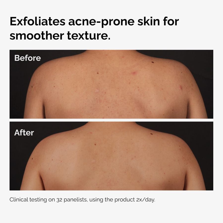 the-body-care-collection-b1 ord-salicylic-acid-body-serum-before-after-graphic-NA.jpg